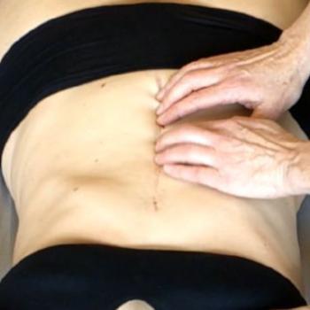 Rolﬁng® und Narben