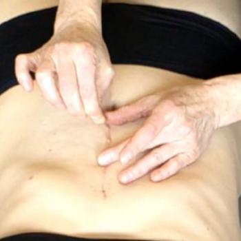 Rolﬁng® und Narben
